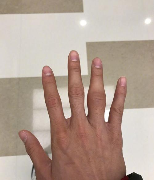 澳门码今晚开什么特号和挖鼻孔满脸肿胀变形与挖鼻孔满脸肿胀变形怎么办